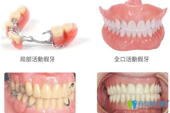 周蕾醫(yī)生告訴大家年輕人適合安活動義齒嗎