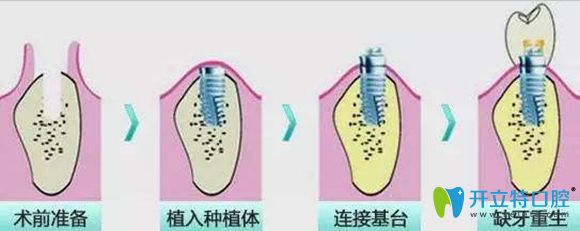 洛陽(yáng)牙大夫口腔種植牙價(jià)格3999元一顆起