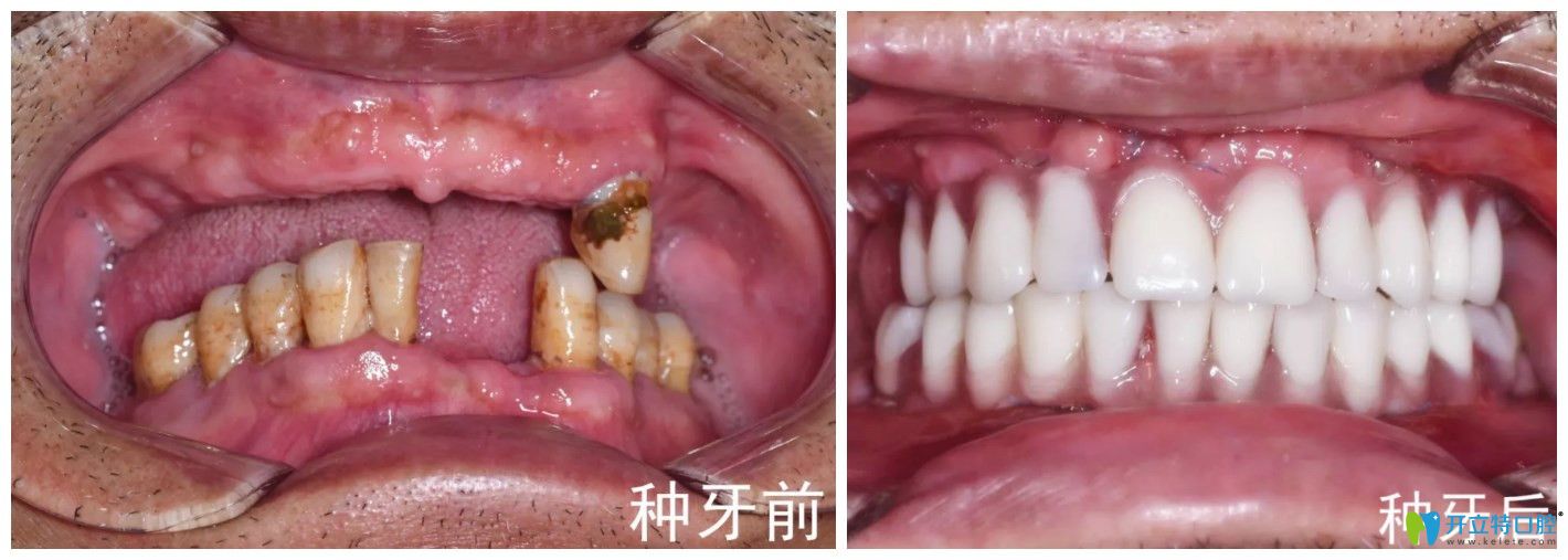 長(zhǎng)沙中諾口腔立得用全口中種植牙對(duì)比圖