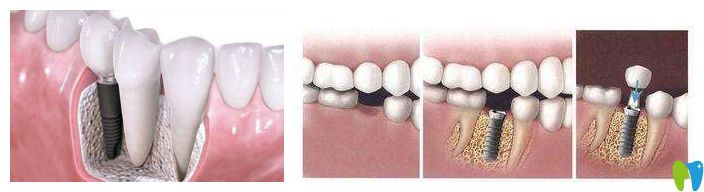 種植牙介紹圖 種植牙介紹圖