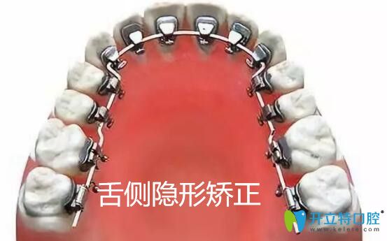 做舌側牙齒矯正會大舌頭嗎?從舌側隱形矯正的優(yōu)缺點來了解