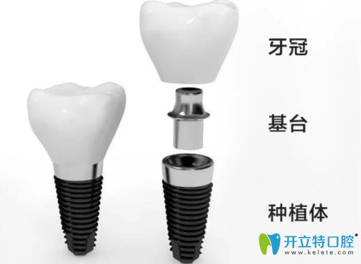 種植牙組成圖片