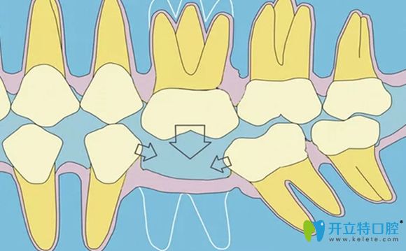 一顆牙齒缺失會影響臨牙的健康 一顆牙齒缺失會影響臨牙的健康