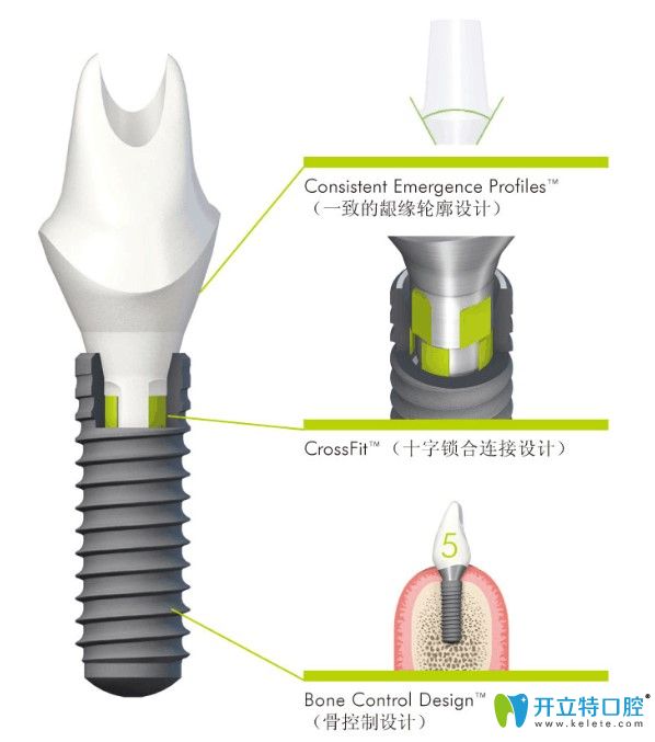 straumann骨水平種植體好嗎