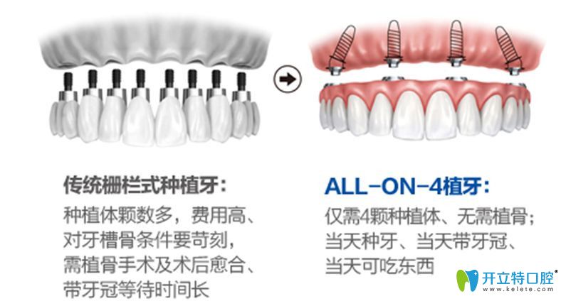 東莞好佰年All-on-4即刻負重種植技術(shù)