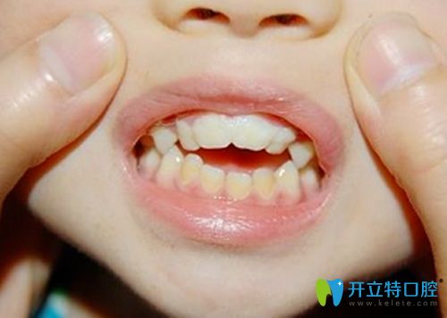 錯(cuò)位咬合圖