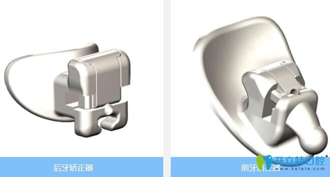 ebrace/易美正畸自鎖矯正 