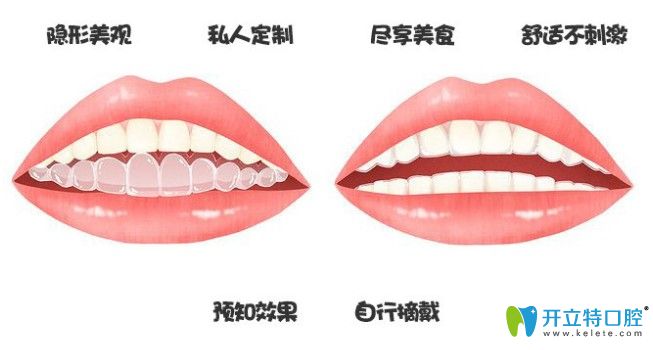 廣州壹加壹口腔可0元試戴隱形牙套