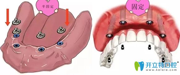 半口半固定和固定種植修復(fù)對(duì)比圖