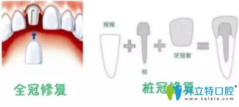 全瓷冠修復(fù)