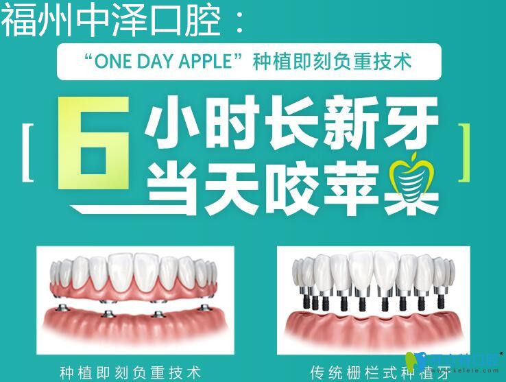 福州中澤口腔即刻負(fù)重種植牙技術(shù)
