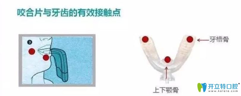 通過牙齒矯正加速器的原理來了解美國美速達(dá)正畸加速器吧