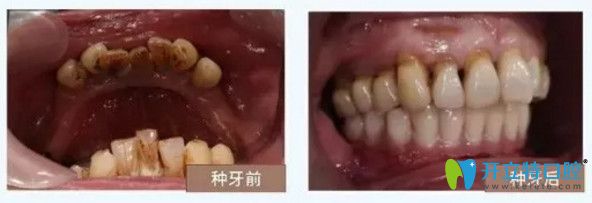 南寧柏樂口腔種植牙對比圖