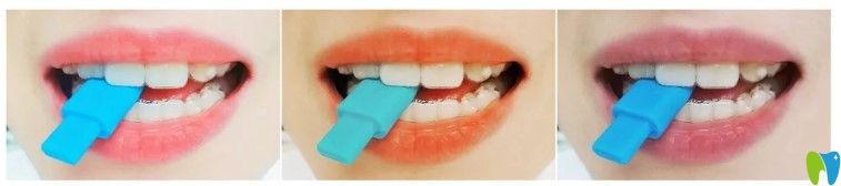 隱適美牙套需要戴多長(zhǎng)時(shí)間