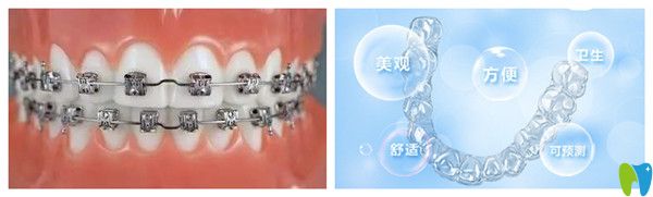 傳統(tǒng)矯正和隱形矯正對(duì)比圖 傳統(tǒng)矯正和隱形矯正對(duì)比圖