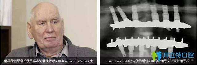 種植牙使用<span style=