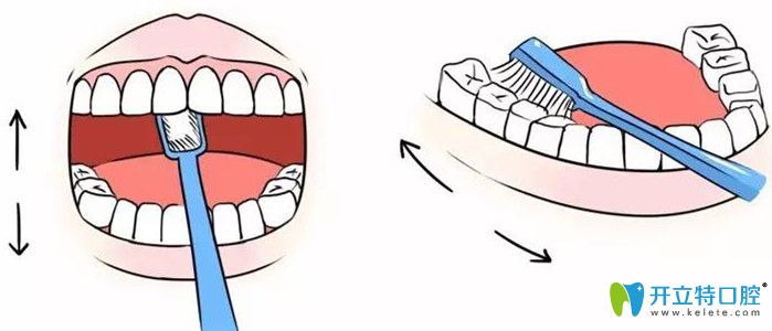 種植牙一般能用多長時間