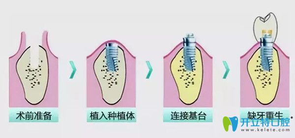 深圳德貝美種植牙怎么樣？從種植牙費用及特色技術(shù)分析