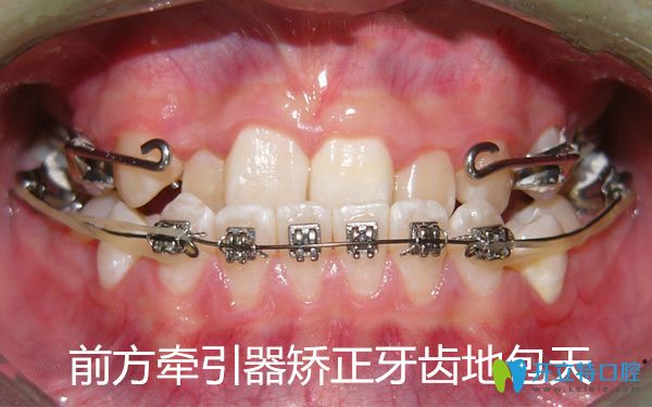 前方牽引器矯正牙齒地包天