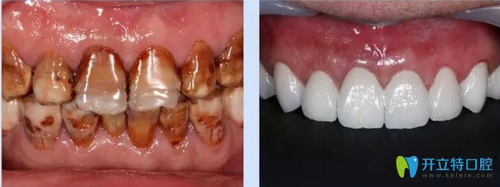 南寧柏樂(lè)口腔重度四環(huán)素牙全瓷冠修復(fù)對(duì)比圖