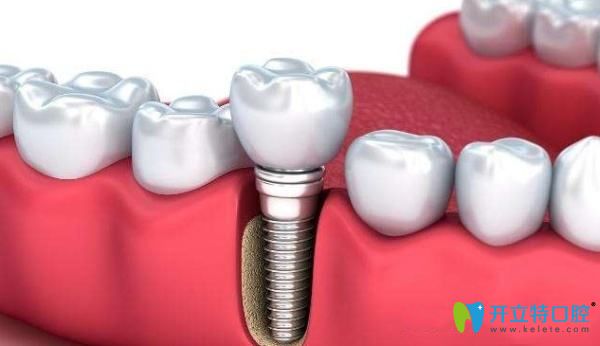 德國(guó)進(jìn)口種植牙圖 德國(guó)進(jìn)口種植牙圖