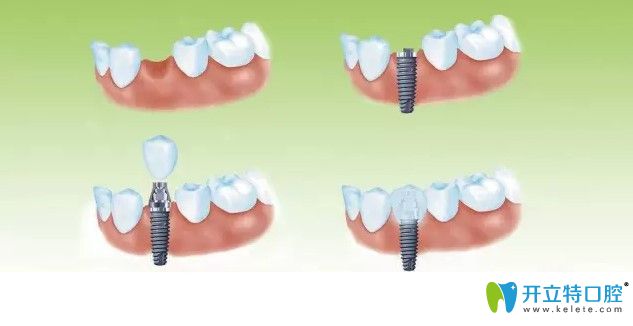 醫(yī)生技術(shù)水平不到位會導(dǎo)致種植牙失敗