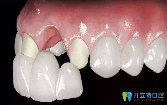 張麗華醫(yī)生告訴大家十八歲之前做烤瓷牙的后果有哪些