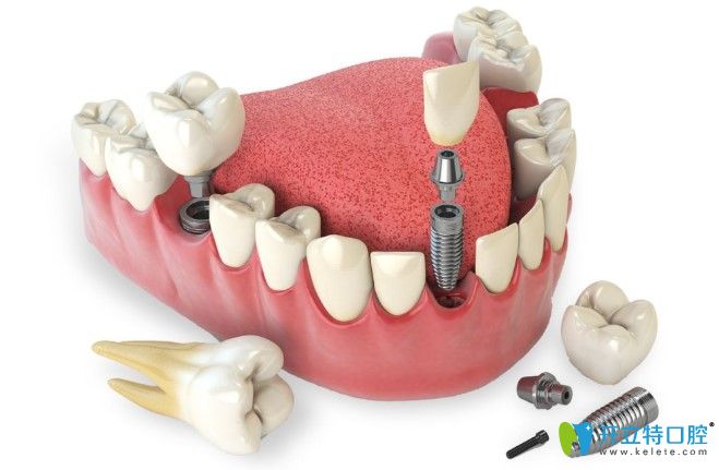 李奇?zhèn)メt(yī)生告訴你種植牙能用多長時間 李奇?zhèn)メt(yī)生告訴你種植牙能用多長時間