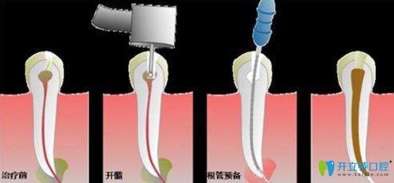 李文英講解什么是根管治療牙齒