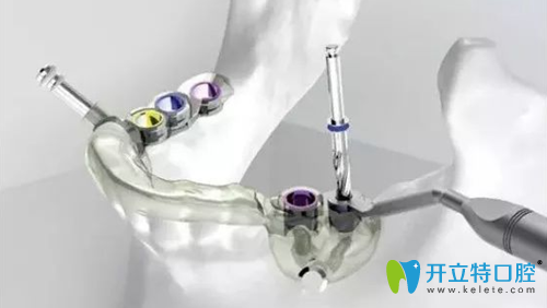 數(shù)字化導(dǎo)板技術(shù)種植牙示意圖