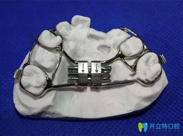 hass上頜快速擴弓矯治器