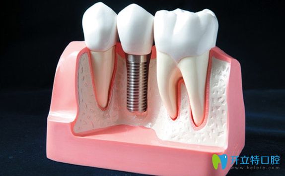 每個種植牙品牌都有自己的特色和優(yōu)勢