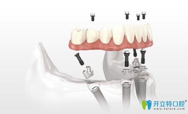 成都圣貝牙科種植牙技術(shù)