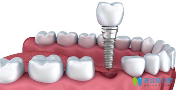 北樂(lè)口腔即刻種植技術(shù)