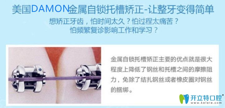 美國(guó)damon自鎖托槽矯正優(yōu)勢(shì)