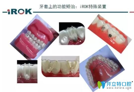 IROK矯治器的特點(diǎn)