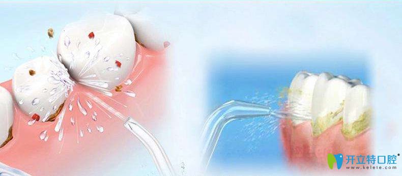 億大口腔洗牙圖示