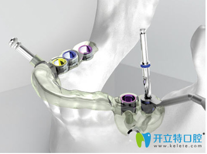 銀川和仁堂口腔3D全數(shù)字化導板種植牙的優(yōu)勢