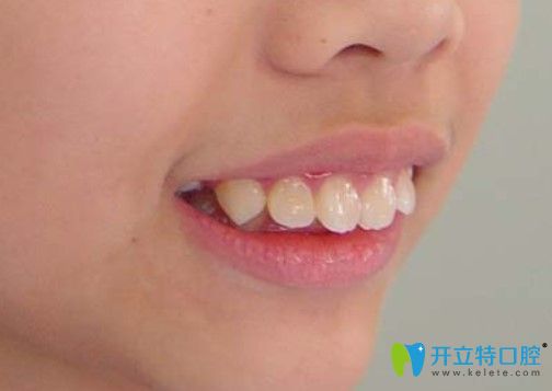 雷慧云醫(yī)生科普：青少年到底應(yīng)該幾歲開始矯正