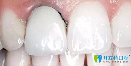 深圳全瓷牙多少錢?參考威蘭德、愛爾創(chuàng)二氧化鋯全瓷牙價(jià)格