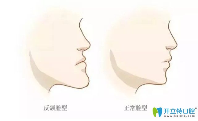 畸形牙齒影響面部軟組織發(fā)育