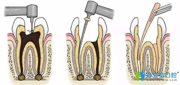 根管治療過(guò)程示意圖