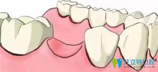 牙齒缺失不及時修復的危害