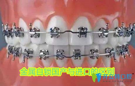 金屬自鎖托槽是國產還是進口的好,不妨看看兩個牙套的區(qū)別