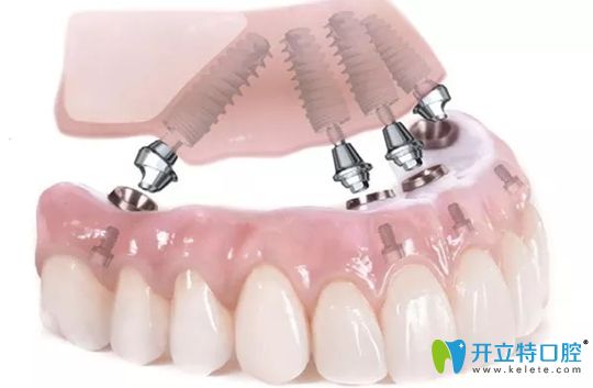 無錫北極星All-on-4半口種植技術(shù) 無錫北極星All-on-4半口種植技術(shù)