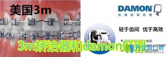 美國(guó)damon矯正器與3m的區(qū)別