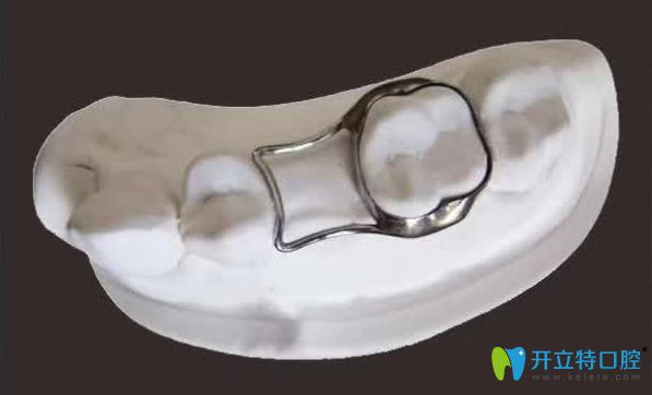 間隙保持器圖示