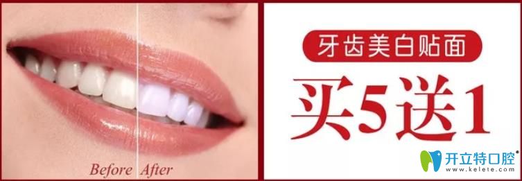 廈門登特口腔牙齒貼面活動(dòng)