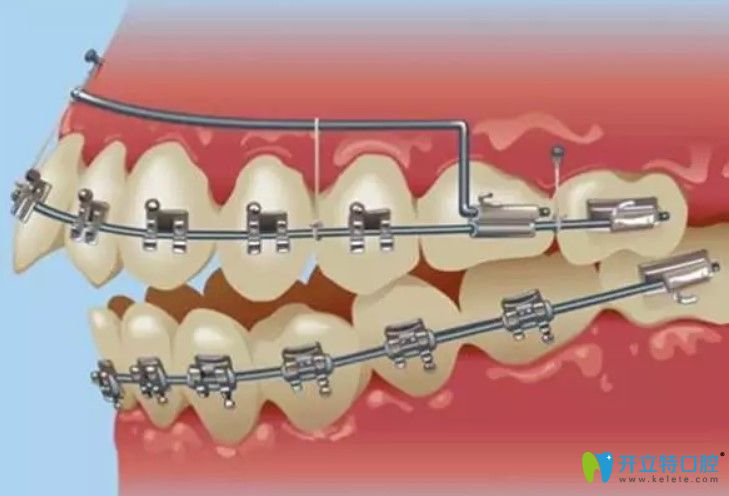 德國非凡自鎖托槽圖片