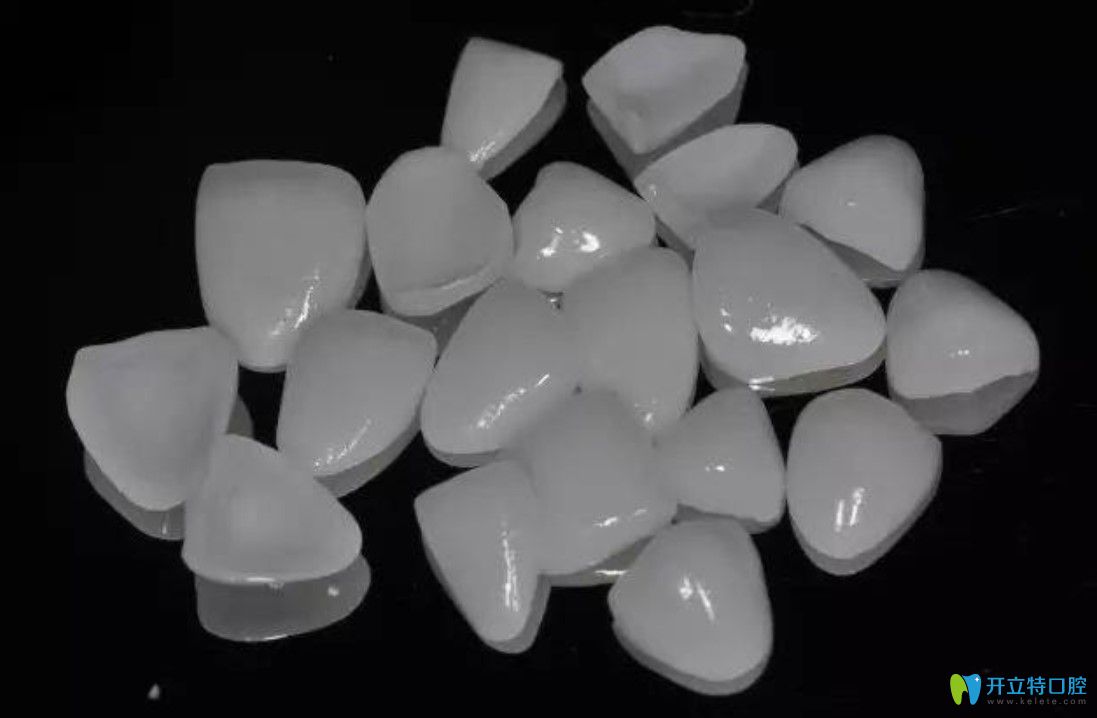 全瓷牙貼面價(jià)格